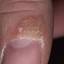 66. Papilloma on Finger Pictures