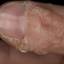 67. Papilloma on Finger Pictures