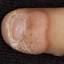 69. Papilloma on Finger Pictures