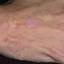 1. Papilloma on Hands Pictures