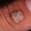 2. Papilloma on Hands Pictures