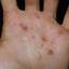 24. Papilloma on Hands Pictures