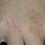 29. Papilloma on Hands Pictures