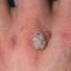 37. Papilloma on Hands Pictures