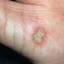 38. Papilloma on Hands Pictures