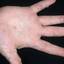 40. Papilloma on Hands Pictures