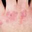 48. Papilloma on Hands Pictures