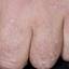 49. Papilloma on Hands Pictures