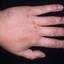 6. Papilloma on Hands Pictures