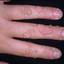 7. Papilloma on Hands Pictures
