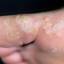 10. Papilloma Toe Pictures