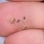 16. Papilloma Toe Pictures