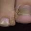 18. Papilloma Toe Pictures