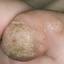 25. Papilloma Toe Pictures