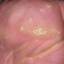 4. Papilloma Toe Pictures