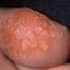 5. Papilloma Toe Pictures