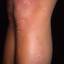 1. Papilloma on Legs Pictures