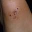 14. Papilloma on Legs Pictures