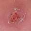 2. Papilloma on Legs Pictures