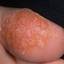 23. Papilloma on Legs Pictures