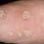 41. Papilloma on Legs Pictures