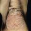 45. Papilloma on Legs Pictures