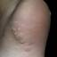 65. Papilloma on Legs Pictures