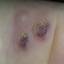 66. Papilloma on Legs Pictures