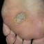 71. Papilloma on Legs Pictures
