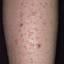 84. Papilloma on Legs Pictures