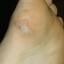 87. Papilloma on Legs Pictures