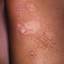 89. Papilloma on Legs Pictures