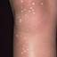 93. Papilloma on Legs Pictures