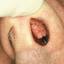 12. Papilloma nose Pictures