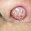 17. Papilloma nose Pictures
