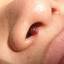 4. Papilloma nose Pictures