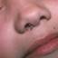 9. Papilloma nose Pictures
