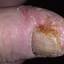 15. Eczema in Humans Pictures