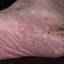 20. Eczema in Humans Pictures