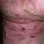 24. Eczema in Humans Pictures