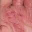 26. Eczema in Humans Pictures