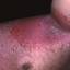 28. Eczema in Humans Pictures