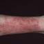 30. Eczema in Humans Pictures