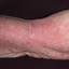 31. Eczema in Humans Pictures