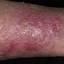 40. Eczema in Humans Pictures