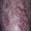 5. Eczema in Humans Pictures