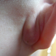 Ear Furuncle