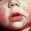 1. Eczema in infants Pictures