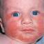 14. Eczema in infants Pictures