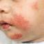 2. Eczema in infants Pictures